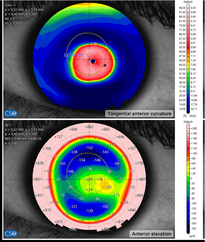 Mappe topografiche della cornea di un occhio con cheratocono: in alto la curvatura, con la zona del cono in rosso; in basso l'elevazione della superficie.